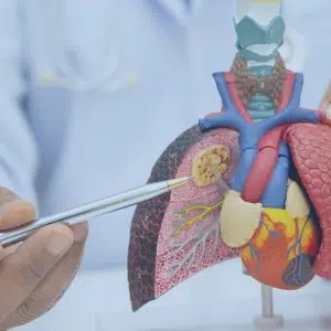 Treating Lung Cancer: Understanding Surgery, Radiation, Chemotherapy, Targeted Therapy, and Immunotherapy