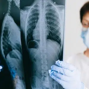 What Is Lung Cancer? Causes, Types, Stages, and Myths Explained